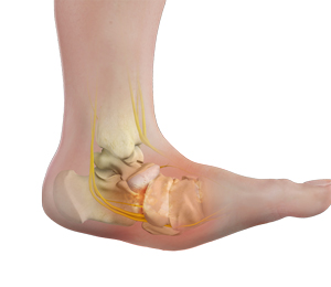 Charcot Foot Deformity