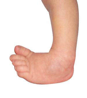Congenital Limb Deformities
