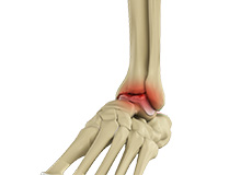 Foot and Ankle Arthritis