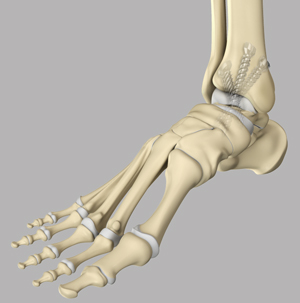 Ankle Arthrodesis 