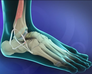 Ankle Ligament Reconstruction