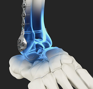 Ankle Stabilization