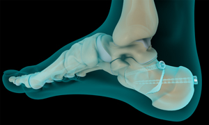 Calcaneal Fracture