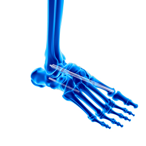 Charcot Reconstruction