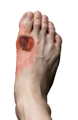 Diabetic Foot Conditions