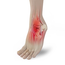 Foot Pain