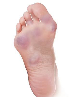 Foot Rheumatoid Arthritis