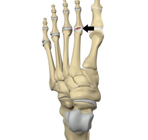 Freiberg's Disease