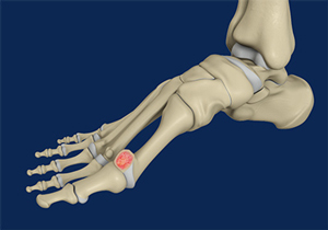 Hallux Rigiditis