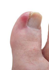 Ingrown toenail