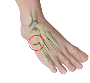 Metatarsal Surgery