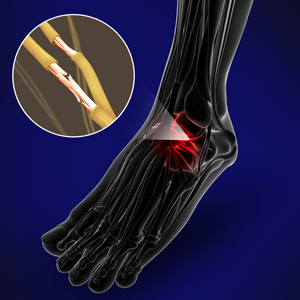 Nerve Conditions of the Foot