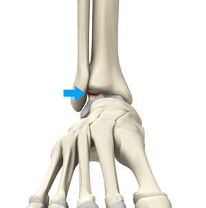 Osteochondral Injuries of the Ankle