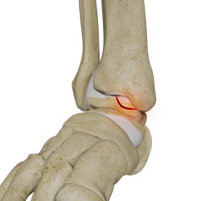 Osteochondral Lesions of the Ankle