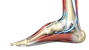 Posterior Tibial Tendon Dysfunction Fort Worth TX | Tenosynovectomy ...