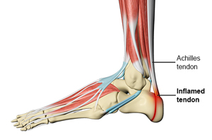 Sever's Disease