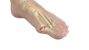 Stiff Big Toe (Hallux Rigidus)