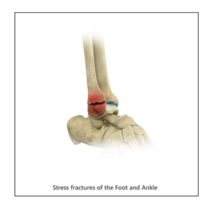 Stress Fractures of Foot and Ankle