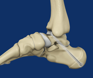 Subtalar Arthrodesis